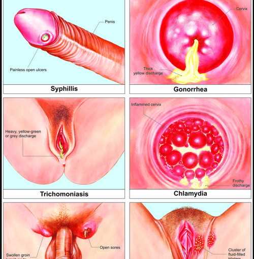 is klebsiella uti sexually transmitted